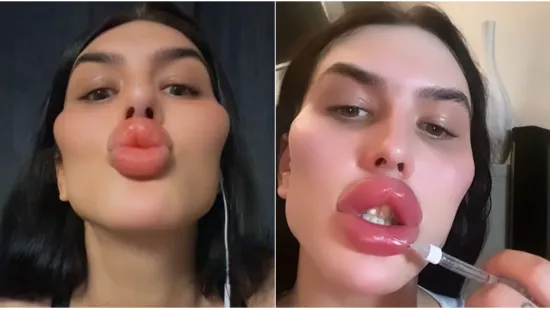 Godinama je punila obraze filerima, a sada je odlučila vratiti prirodno lice: Promjena je ogromna